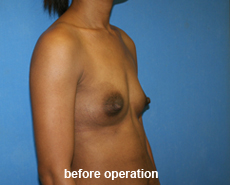 plastic-surgery-breast-augmentation